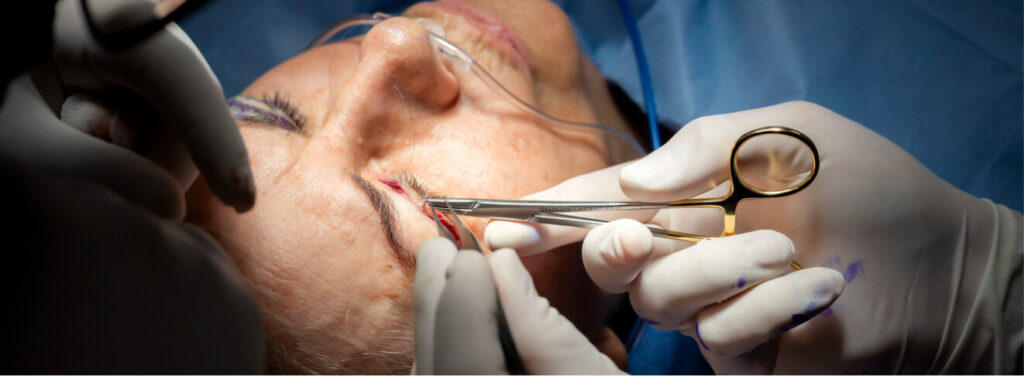 Surgeon performing a blepharoplasty procedure.