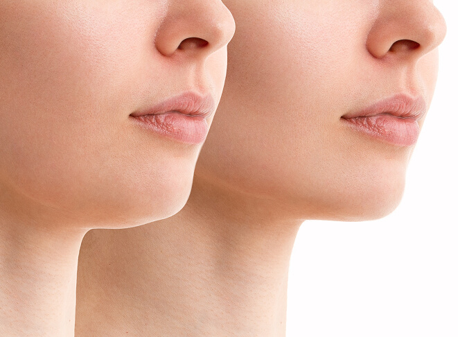 Two side profiles of a woman showing the difference of fat reduction in the face.