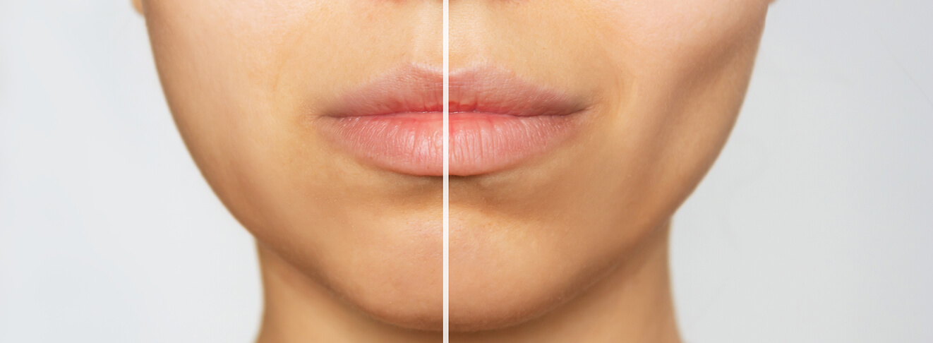 Before and after image of fat reduction in the cheeks.