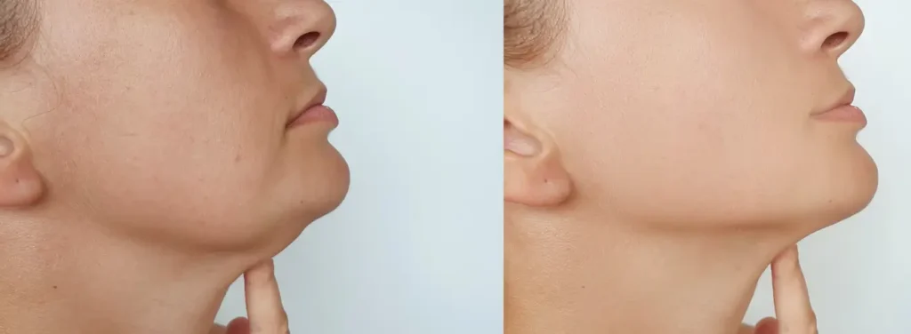 Before and after neck lift results showing reduced submental fat and improved jawline definition